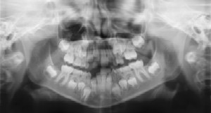 Pediatric Dentist in High Point, NC - Dental Radiographs (X-Rays)