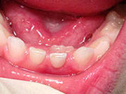 Baby Teeth - Pediatric Dentist in High Point, NC